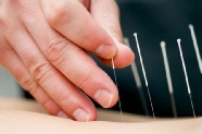 #Acupuncture
